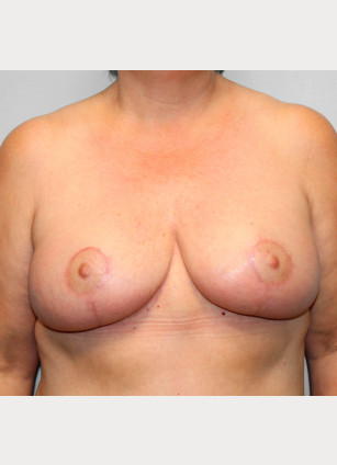 After Image: Breast Reduction, Tummy Tuck & Lipo- Dr.Howell - front
