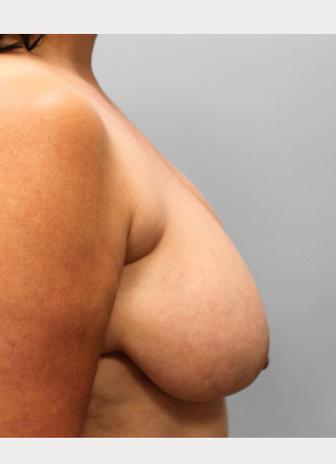 Before Image: Breast Reduction, Tummy Tuck & Lipo- Dr.Howell - right-side