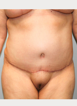 After Image: Breast Reduction, Tummy Tuck & Lipo- Dr.Howell - front