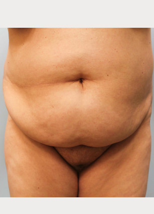 Before Image: Breast Reduction, Tummy Tuck & Lipo- Dr.Howell - front