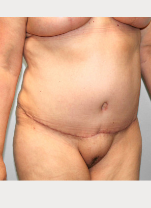 After Image: Breast Reduction, Tummy Tuck & Lipo- Dr.Howell - right-front-oblique