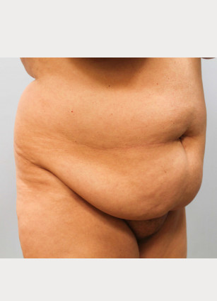 Before Image: Breast Reduction, Tummy Tuck & Lipo- Dr.Howell - right-front-oblique
