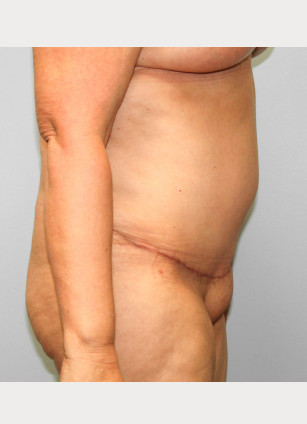 After Image: Breast Reduction, Tummy Tuck & Lipo- Dr.Howell - right-side