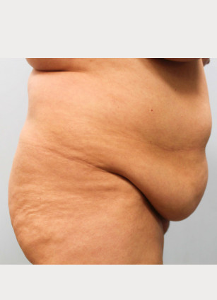 Before Image: Breast Reduction, Tummy Tuck & Lipo- Dr.Howell - right-side