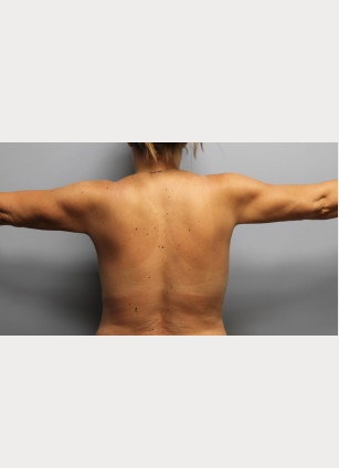 After Image: Arm Lift-Dr.Howell - back