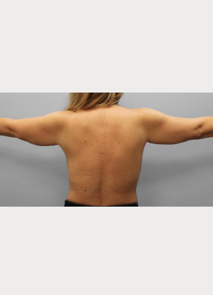 Before Image: Arm Lift-Dr.Howell - back