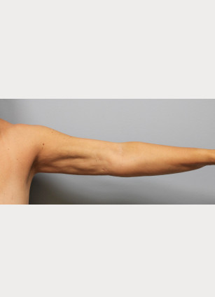 After Image: Arm Lift-Dr.Howell - left-side
