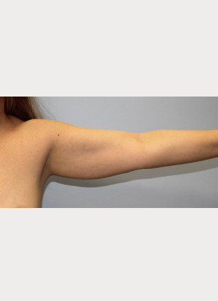 Before Image: Arm Lift-Dr.Howell - left-side