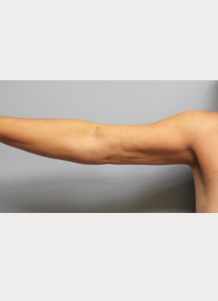 After Image: Arm Lift-Dr.Howell - right-side