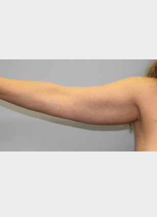 Before Image: Arm Lift-Dr.Howell - right-side