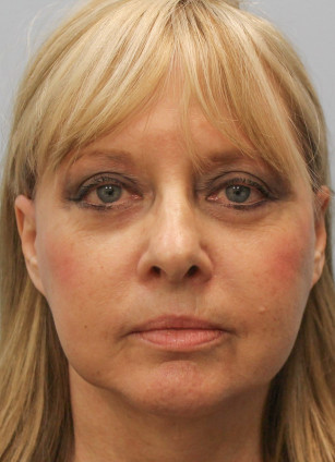 After Image: Facelift with Upper and Lower Bleph-Dr.Howell - front