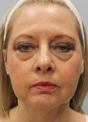 Facelift with Upper and Lower Bleph-Dr.Howell