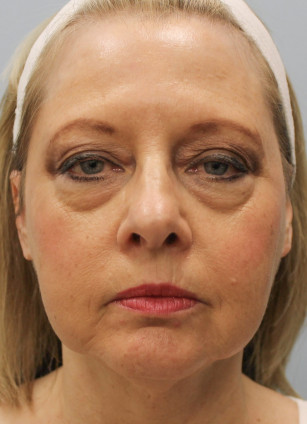 Before Image: Facelift with Upper and Lower Bleph-Dr.Howell - front