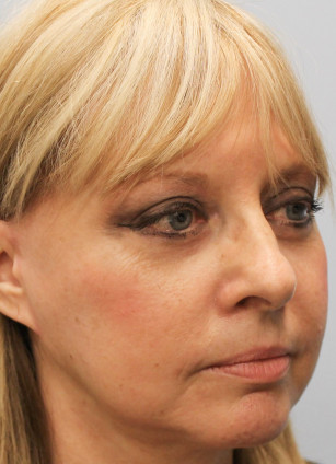 After Image: Facelift with Upper and Lower Bleph-Dr.Howell - right-front-oblique