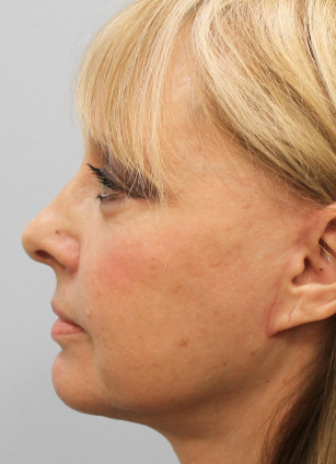 After Image: Facelift with Upper and Lower Bleph-Dr.Howell - left-side