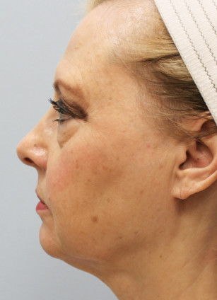 Before Image: Facelift with Upper and Lower Bleph-Dr.Howell - left-side