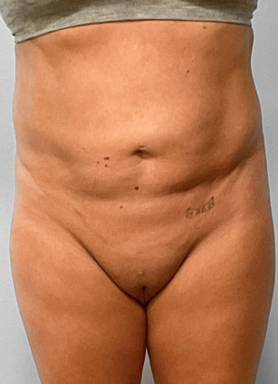 After Image: SmartLipo-Dr.Tucker - front