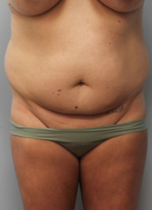 Before Image: SmartLipo-Dr.Tucker - front