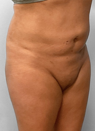 After Image: SmartLipo-Dr.Tucker - right-front-oblique
