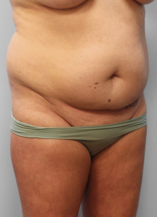 Before Image: SmartLipo-Dr.Tucker - right-front-oblique