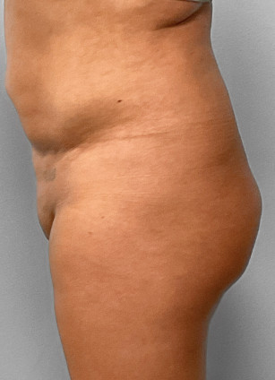 After Image: SmartLipo-Dr.Tucker - left-side
