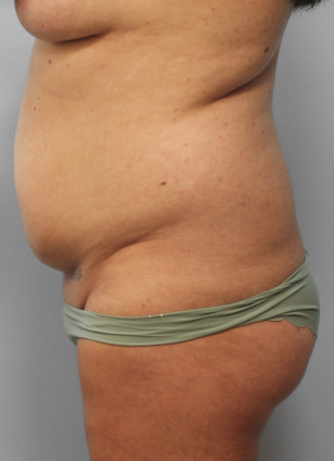 Before Image: SmartLipo-Dr.Tucker - left-side