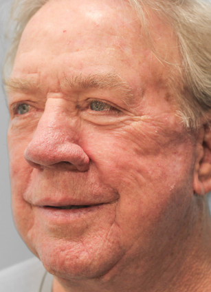 After Image: Facelift-Dr.Tucker - left-front-oblique