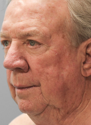 Before Image: Facelift-Dr.Tucker - left-front-oblique