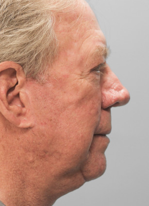 After Image: Facelift-Dr.Tucker - right-side