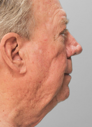 Before Image: Facelift-Dr.Tucker - right-side