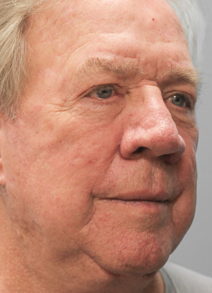 After Image: Facelift-Dr.Tucker - right-front-oblique
