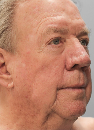 Before Image: Facelift-Dr.Tucker - right-front-oblique
