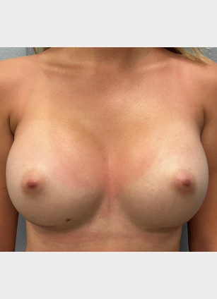 After Image: Breast Augmentation-Dr.Tucker - front