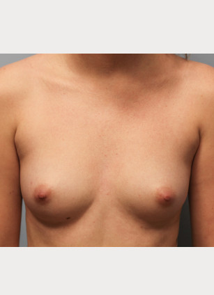 Before Image: Breast Augmentation-Dr.Tucker - front