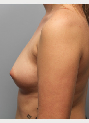 Before Image: Breast Augmentation-Dr.Tucker - left-side