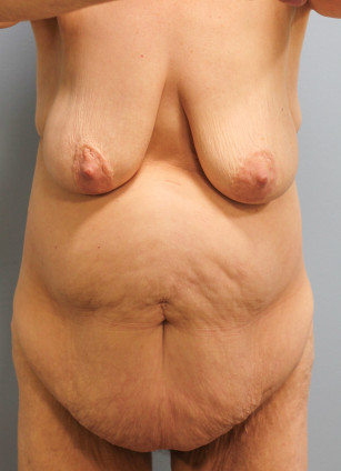 Before Image: Abdominoplasty, Lipo, and Arm Lift-Dr.Tucker - front