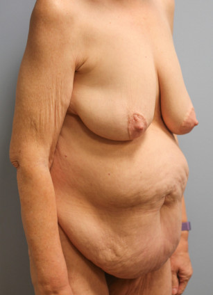 Before Image: Abdominoplasty, Lipo, and Arm Lift-Dr.Tucker - right-front-oblique