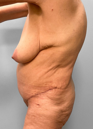 After Image: Abdominoplasty, Lipo, and Arm Lift-Dr.Tucker - left-side