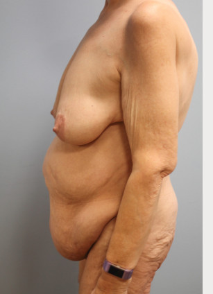Before Image: Abdominoplasty, Lipo, and Arm Lift-Dr.Tucker - left-side
