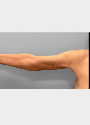 After Image: Abdominoplasty, Lipo, and Arm Lift-Dr.Tucker - right-side