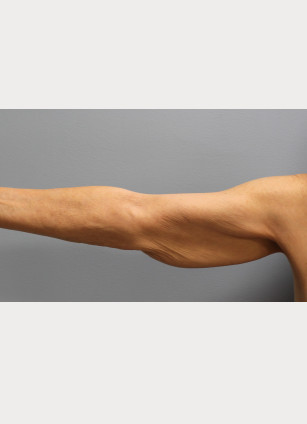 Before Image: Abdominoplasty, Lipo, and Arm Lift-Dr.Tucker - right-side