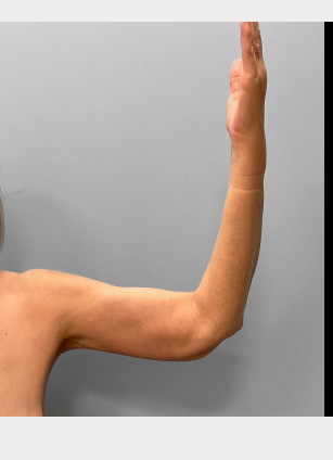 After Image: Abdominoplasty, Lipo, and Arm Lift-Dr.Tucker - left-side