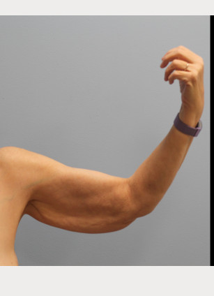 Before Image: Abdominoplasty, Lipo, and Arm Lift-Dr.Tucker - left-side