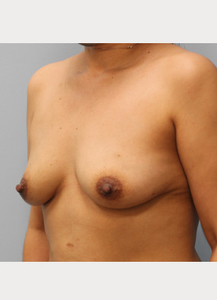Before Image: Breast Augmentation-Dr.Tucker - left-front-oblique