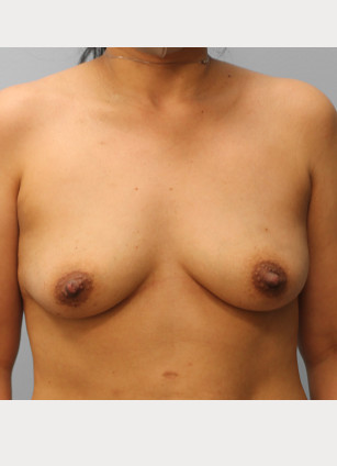 Before Image: Breast Augmentation-Dr.Tucker - front