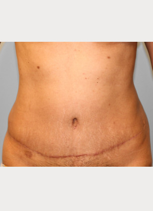 After Image: Abdominoplasty & Lipo-Dr.Tucker - front