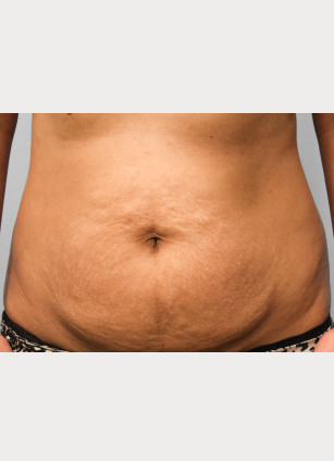 Before Image: Abdominoplasty & Lipo-Dr.Tucker - front
