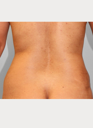 After Image: Abdominoplasty & Lipo-Dr.Tucker - back