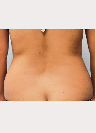 Before Image: Abdominoplasty & Lipo-Dr.Tucker - back