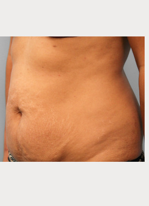 Before Image: Abdominoplasty & Lipo-Dr.Tucker - left-front-oblique